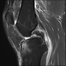 PCL Peel off MRI